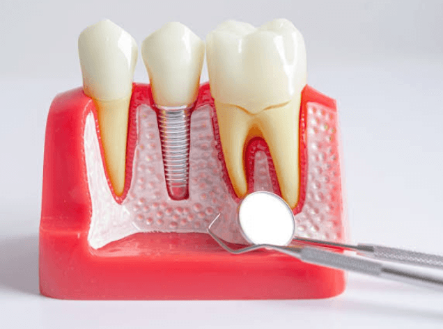 3 Signs You May Be A Candidate For Dental Implants
